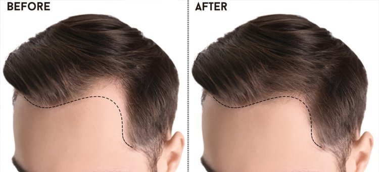 The Best Hair Transplants in Pakistan: A Comprehensive Guide