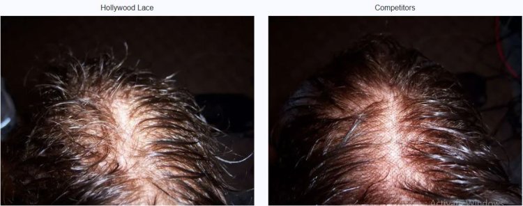 Discover the Power of a Skin Hair System for Hair Restoration