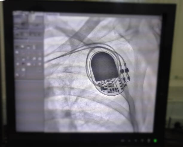 Asia Pacific Electrophysiology Mapping And Ablation Device Market Dynamics – Driver, Challenge, Segment & Competition FY2025