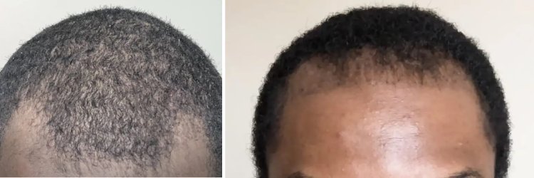 Why Afro Hair Requires a Specialized Hair Transplant Approach