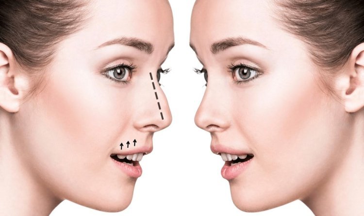 Nose Fillers in Dubai: A Safe and Effective Solution for a Perfect Nose