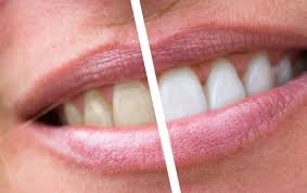 Best Teeth Whitening in Dubai: Achieve a Brighter Smile Today