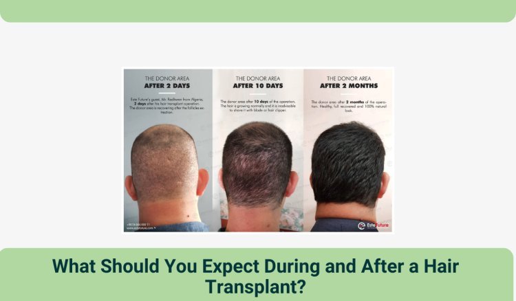 What Should You Expect During and After a Hair Transplant?