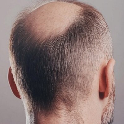 Does a Crown Hair Transplant Give Permanent Results?