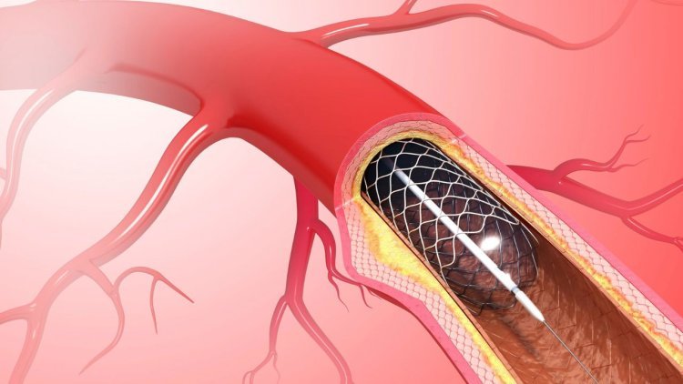 Difference Between Angiography and Angioplasty